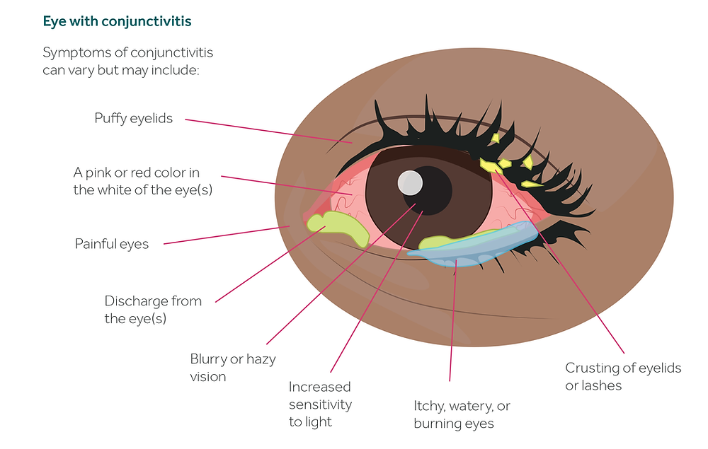 Conjuctivitis On A Rise | Youth Ki Awaaz